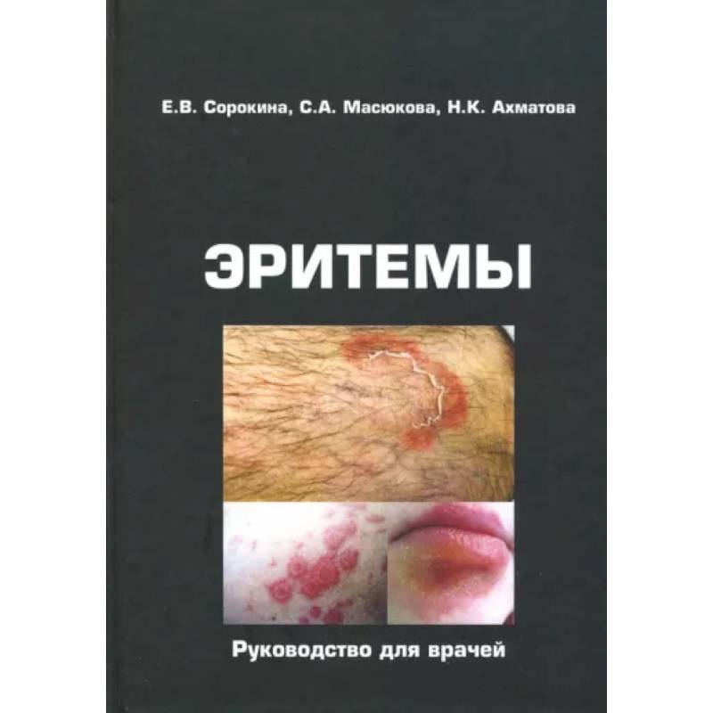 Эритемы. Руководство для врачей